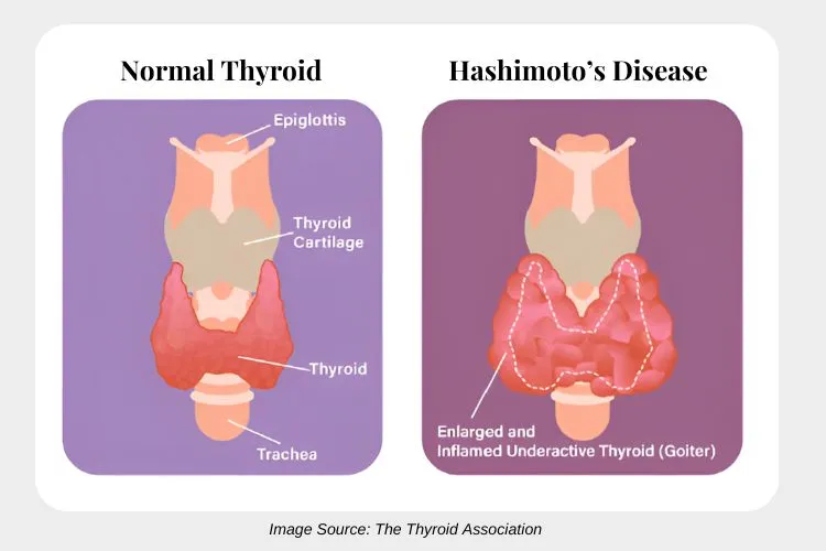 Hashimoto Graphic